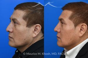 Photo of a patient before and after a procedure. Rhinoplasty for Droopy TIp - This gentleman had suffered a nasal fracture and noted breathing obstruction and poor nasal tip support which gave his nasal tip a droopy appearance. Septoplast was performed to restore his breathing. An open rhinoplasty approach was used to place bilateral septum extension grafts and a cap graft to improve the position and contour of the nose. He is ecstatic about his breathing capacity and nasal appearance following his rhinoplasty in New York.