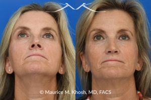 Photo of a patient before and after a procedure. Upper Blepharoplasty and Rhinoplasty - Upper blepharoplasty and rhinoplasty to decrease nasal tip projection. 