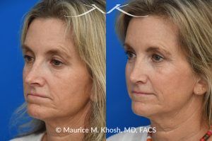 Photo of a patient before and after a procedure. Upper Blepharoplasty and Rhinoplasty - Upper blepharoplasty and rhinoplasty to decrease nasal tip projection. 