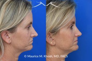 Photo of a patient before and after a procedure. Upper Blepharoplasty and Rhinoplasty - Upper blepharoplasty and rhinoplasty to decrease nasal tip projection. 