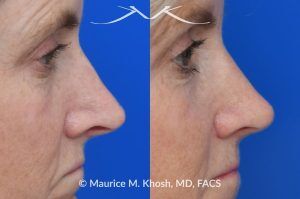 Photo of a patient before and after a procedure. Upper Blepharoplasty and Rhinoplasty - Upper blepharoplasty and rhinoplasty to decrease nasal tip projection. 