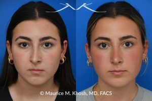 Photo of a patient before and after a procedure. Rhinoplasty to Improve Breathing, Correct Nasal Deviation, and Reduce Nasal Hump  - before-and-after composite photo.