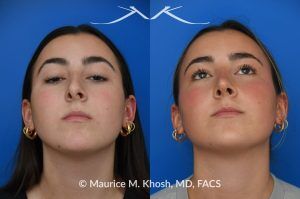 Photo of a patient before and after a procedure. Rhinoplasty to Improve Breathing, Correct Nasal Deviation, and Reduce Nasal Hump  - before-and-after composite photo.
