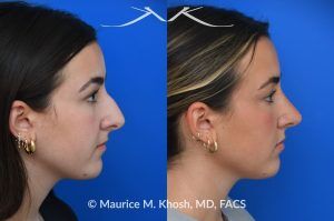 Photo of a patient before and after a procedure. Rhinoplasty to Improve Breathing, Correct Nasal Deviation, and Reduce Nasal Hump  - before-and-after composite photo.