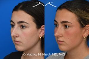Photo of a patient before and after a procedure. Rhinoplasty to Improve Breathing, Correct Nasal Deviation, and Reduce Nasal Hump  - before-and-after composite photo.