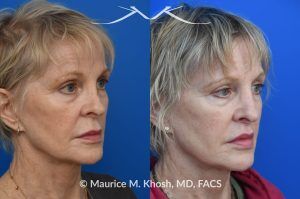 Photo of a patient before and after a procedure. Lip Lift - before and after photo showing enhanced shape and definition of the lips.