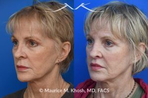 Photo of a patient before and after a procedure. Lip Lift - before and after photo showing enhanced shape and definition of the lips.