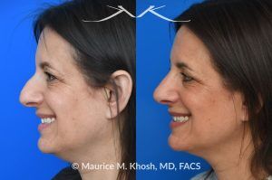 Photo of a patient before and after a procedure. Rhinoplasty for Nasal Hump and Droopy Tip - before-and-after composite photo.