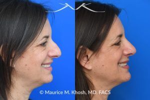 Photo of a patient before and after a procedure. Rhinoplasty for Nasal Hump and Droopy Tip - before-and-after composite photo.