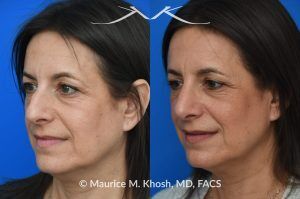 Photo of a patient before and after a procedure. Rhinoplasty for Nasal Hump and Droopy Tip - before-and-after composite photo.