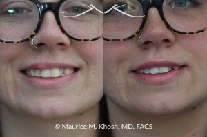 Photo of a patient before and after a procedure. Right Upper Lip Scar Removal - Prior trauma had resulted in a visible mass in the right upper lip. Scar revision of the lip allowed restoration of normal lip contour.