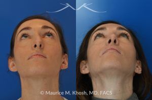 Photo of a patient before and after a procedure. Rhinoplasty for Crooked Nose, Nasal Hump, and Hanging Columella Correction - This amazing 28 year-old had sustained a nose fracture at age eight which left her nose crooked to the left. She had severe nasal obstruction. Rhinoplasty though the open approach allowed correction of her crooked nose, smoothing of nasal hump, and push back of the hanging columella which was most notable on profile view.