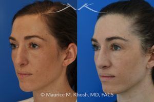 Photo of a patient before and after a procedure. Rhinoplasty for Crooked Nose, Nasal Hump, and Hanging Columella Correction - This amazing 28 year-old had sustained a nose fracture at age eight which left her nose crooked to the left. She had severe nasal obstruction. Rhinoplasty though the open approach allowed correction of her crooked nose, smoothing of nasal hump, and push back of the hanging columella which was most notable on profile view.