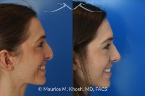 Photo of a patient before and after a procedure. Rhinoplasty for Crooked Nose, Nasal Hump, and Hanging Columella Correction - This amazing 28 year-old had sustained a nose fracture at age eight which left her nose crooked to the left. She had severe nasal obstruction. Rhinoplasty though the open approach allowed correction of her crooked nose, smoothing of nasal hump, and push back of the hanging columella which was most notable on profile view.