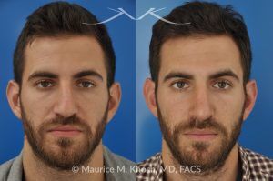 Photo of a patient before and after a procedure. Rhinoplasty to Correct Crooked Nose with Droopy Tip - before-and-after composite photo.