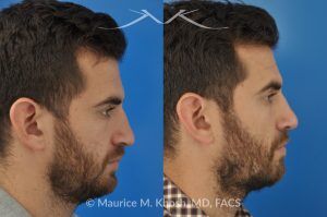 Photo of a patient before and after a procedure. Rhinoplasty to Correct Crooked Nose with Droopy Tip - before-and-after composite photo.
