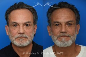 Photo of a patient before and after a procedure. Rib Cartilage Rhinoplasty with Dorsal Hump Reduction and Tip Refinement - Rhinoplasty Using Autologous Rib Cartilage to Correct High Dorsal Septal Deviation Following Unsuccessful Septoplasty, with Simultaneous Dorsal Hump Reduction and Nasal Tip Rotation.