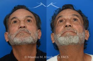 Photo of a patient before and after a procedure. Rib Cartilage Rhinoplasty with Dorsal Hump Reduction and Tip Refinement - Rhinoplasty Using Autologous Rib Cartilage to Correct High Dorsal Septal Deviation Following Unsuccessful Septoplasty, with Simultaneous Dorsal Hump Reduction and Nasal Tip Rotation.