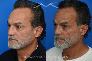 Photo of a patient before and after a procedure. Rib Cartilage Rhinoplasty with Dorsal Hump Reduction and Tip Refinement - Rhinoplasty Using Autologous Rib Cartilage to Correct High Dorsal Septal Deviation Following Unsuccessful Septoplasty, with Simultaneous Dorsal Hump Reduction and Nasal Tip Rotation.