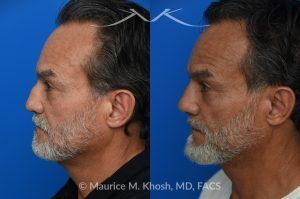 Photo of a patient before and after a procedure. Rib Cartilage Rhinoplasty with Dorsal Hump Reduction and Tip Refinement - Rhinoplasty Using Autologous Rib Cartilage to Correct High Dorsal Septal Deviation Following Unsuccessful Septoplasty, with Simultaneous Dorsal Hump Reduction and Nasal Tip Rotation.