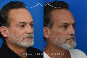 Photo of a patient before and after a procedure. Rib Cartilage Rhinoplasty with Dorsal Hump Reduction and Tip Refinement - Rhinoplasty Using Autologous Rib Cartilage to Correct High Dorsal Septal Deviation Following Unsuccessful Septoplasty, with Simultaneous Dorsal Hump Reduction and Nasal Tip Rotation.