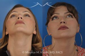 Photo of a patient before and after a procedure. Rhinoplasty to Correct Saddle Nose Deformity Caused by Autoimmune Condition - 27 year old with saddle nose collapse due to an autoimmune condition. She was bothered by the unnatural sag of the bridge of the nose, loss of nasal tip definition, and nasal obstruction. Her own rib cartilage was used during saddle nose rhinoplasty, to reconstruct the nose and restore breathing. The last two images show the computer simulation of surgical outcome (middle picture), as well as the final outcome (the picture on the right side). Patient is delighted with her results. 