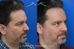 Photo of a patient before and after a procedure. Endoscopic Forehead Lipoma Removal - This patient presented with a subtle, 1-inch diameter bump in the center of the forehead caused by a lipoma—a benign fatty tumor. The mass was removed endoscopically through a concealed hairline incision, leaving no visible scarring and restoring a smooth forehead contour.