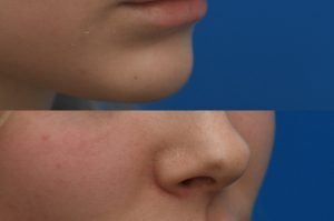 Photo of a patient before and after a procedure. Lip Augmentation with HA Filler - Before and after photo showing improved fullness and symmetry of the lips.