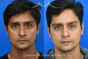 Photo of a patient before and after a procedure. Rhinoplasty for Hump Reduction, Tip Elevation, and Nasal Refinement - Rhinoplasty was performed through the open approach to reduce the nasal hump (radix graft as well as dorsal shave), elevate the tip (septo-columellar sutures), and refine the lower nose (alar strut grafts and cephalic trimming). The patient is ecstatic about the final outcome which is completely natural and perfectly complementary to his face. 