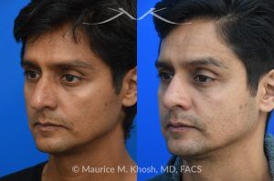 Photo of a patient before and after a procedure. Rhinoplasty for Hump Reduction, Tip Elevation, and Nasal Refinement - Rhinoplasty was performed through the open approach to reduce the nasal hump (radix graft as well as dorsal shave), elevate the tip (septo-columellar sutures), and refine the lower nose (alar strut grafts and cephalic trimming). The patient is ecstatic about the final outcome which is completely natural and perfectly complementary to his face. 