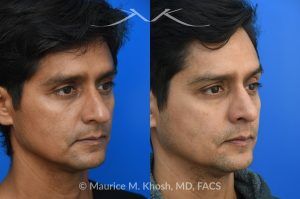 Photo of a patient before and after a procedure. Rhinoplasty for Hump Reduction, Tip Elevation, and Nasal Refinement - Rhinoplasty was performed through the open approach to reduce the nasal hump (radix graft as well as dorsal shave), elevate the tip (septo-columellar sutures), and refine the lower nose (alar strut grafts and cephalic trimming). The patient is ecstatic about the final outcome which is completely natural and perfectly complementary to his face. 