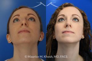 Photo of a patient before and after a procedure. Nasal Hump Reduction and Tip Elevation - This 27 year old requested rhinoplasty in New York to address a large nasal hump and to improve the nasal tip in a subtle and natural manner. The images show her before and after photos 6 months after surgery. The last two images show our computer simulation of the appearance of the bridge of her nose, in the middle images. Note the similarity of the simulation photos to the final outcome. 