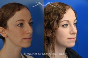 Photo of a patient before and after a procedure. Nasal Hump Reduction and Tip Elevation - This 27 year old requested rhinoplasty in New York to address a large nasal hump and to improve the nasal tip in a subtle and natural manner. The images show her before and after photos 6 months after surgery. The last two images show our computer simulation of the appearance of the bridge of her nose, in the middle images. Note the similarity of the simulation photos to the final outcome. 