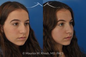 Photo of a patient before and after a procedure. Natural Rhinoplasty: Smoothing the Hump & Refining the Tip - before-and-after composite photo.