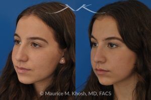 Photo of a patient before and after a procedure. Natural Rhinoplasty: Smoothing the Hump & Refining the Tip - before-and-after composite photo.
