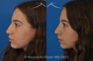 Photo of a patient before and after a procedure. Natural Rhinoplasty: Smoothing the Hump & Refining the Tip - before-and-after composite photo.