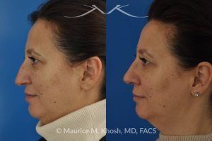 Photo of a patient before and after a procedure. Nose Job for Drooping Tip and Dorsal Hump Correction - This patient underwent rhinoplasty to correct a prominent dorsal hump and a drooping nasal tip. The procedure focused on refining the nasal profile and achieving a more balanced, elevated tip. The results improved both the appearance and harmony of the patient’s facial features.