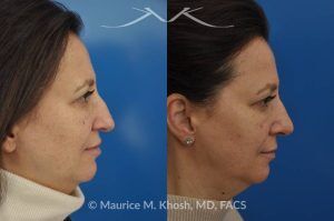 Photo of a patient before and after a procedure. Nose Job for Drooping Tip and Dorsal Hump Correction - This patient underwent rhinoplasty to correct a prominent dorsal hump and a drooping nasal tip. The procedure focused on refining the nasal profile and achieving a more balanced, elevated tip. The results improved both the appearance and harmony of the patient’s facial features.
