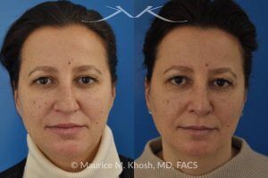 Photo of a patient before and after a procedure. Nose Job for Drooping Tip and Dorsal Hump Correction - This patient underwent rhinoplasty to correct a prominent dorsal hump and a drooping nasal tip. The procedure focused on refining the nasal profile and achieving a more balanced, elevated tip. The results improved both the appearance and harmony of the patient’s facial features.