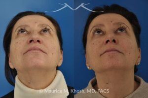 Photo of a patient before and after a procedure. Nose Job for Drooping Tip and Dorsal Hump Correction - This patient underwent rhinoplasty to correct a prominent dorsal hump and a drooping nasal tip. The procedure focused on refining the nasal profile and achieving a more balanced, elevated tip. The results improved both the appearance and harmony of the patient’s facial features.
