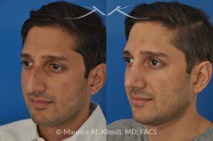 Photo of a patient before and after a procedure. Open Rhinoplasty and Septoplasty for Hump Reduction, Tip Elevation, and Improved Breathing - This procedure involved an open rhinoplasty technique to effectively reduce a prominent nasal hump and elevate a droopy nasal tip for enhanced facial harmony. Additionally, septoplasty was performed to correct nasal septum deviation, improving the patient’s breathing function.