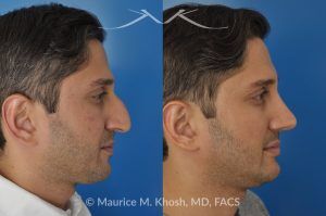 Photo of a patient before and after a procedure. Open Rhinoplasty and Septoplasty for Hump Reduction, Tip Elevation, and Improved Breathing - This procedure involved an open rhinoplasty technique to effectively reduce a prominent nasal hump and elevate a droopy nasal tip for enhanced facial harmony. Additionally, septoplasty was performed to correct nasal septum deviation, improving the patient’s breathing function.