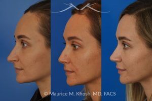 Photo of a patient before and after a procedure. Rhinoplasty to Elevate and Refine the Nasal Tip - This delightful 30 year-old was interested in rhinoplasty in New York, to elevate and refine her nasal tip. An open approach rhinoplasty was used to rotate and shorten the tip. Providing the results which perfectly matched her expectations .