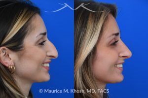 Photo of a patient before and after a procedure. Saddle Nose Rhinoplasty with Rib Cartilage Reconstruction -  This young patient was interested in eliminating her nasal hump and improving her droopy appearing nasal tip. She was also interested in addressing her nasal breathing obstruction. An open approach rhinoplasty was used to achieve a smooth dorsal profile, and elevate and refine her nasal tip. Her deviated septum was also corrected during the surgery.