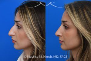 Photo of a patient before and after a procedure. Saddle Nose Rhinoplasty with Rib Cartilage Reconstruction -  This young patient was interested in eliminating her nasal hump and improving her droopy appearing nasal tip. She was also interested in addressing her nasal breathing obstruction. An open approach rhinoplasty was used to achieve a smooth dorsal profile, and elevate and refine her nasal tip. Her deviated septum was also corrected during the surgery.