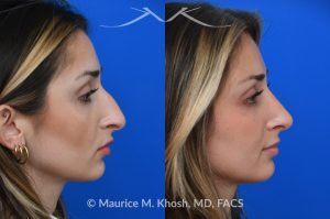 Photo of a patient before and after a procedure. Saddle Nose Rhinoplasty with Rib Cartilage Reconstruction -  This young patient was interested in eliminating her nasal hump and improving her droopy appearing nasal tip. She was also interested in addressing her nasal breathing obstruction. An open approach rhinoplasty was used to achieve a smooth dorsal profile, and elevate and refine her nasal tip. Her deviated septum was also corrected during the surgery.