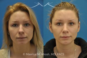 Photo of a patient before and after a procedure. Rhinoplasty and Chin Implant - before-and-after composite photo.