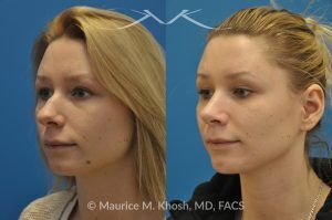 Photo of a patient before and after a procedure. Rhinoplasty and Chin Implant - before-and-after composite photo.
