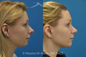 Photo of a patient before and after a procedure. Rhinoplasty and Chin Implant - before-and-after composite photo.