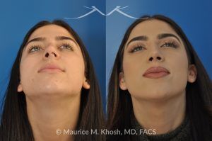 Photo of a patient before and after a procedure. Rhinoplasty and Septoplasty for Hump Removal and Tip Refinement - 21 year old female wanted a nasal hump removed and the tip of her nose refined. She has breathing obstruction due to a crooked septum. She underwent a closed rhinoplasty and septoplasty. during rhinoplasty, the nasal hump was removed, nasal bones were narrowed, and a columellar strut placed to improve her nasal tip position.